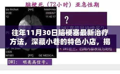 揭秘脑梗塞最新治疗方法,特色小店深藏小巷,带你了解往年11月30日的最新治疗进展